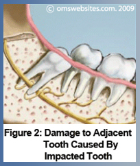 Figure 2 : Damage to Adjacent Tooth Caused By Impacted Tooth